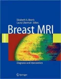 Breast MRI: Diagnosis and Intervention