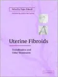 Uterine Fibroids: Embolization and Other Treatment Approaches