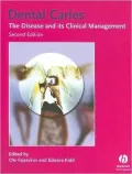 Dental Caries: The Disease and Its Clinical Management