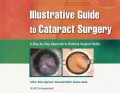 Illustrative Guide to Cataract Surgery