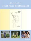 Your Guide to Total Knee Replacement
